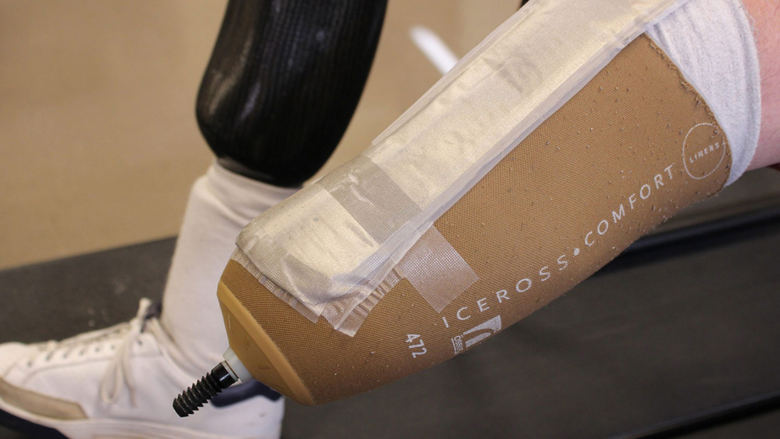 Textile sensor for pressure points in prosthetic limb